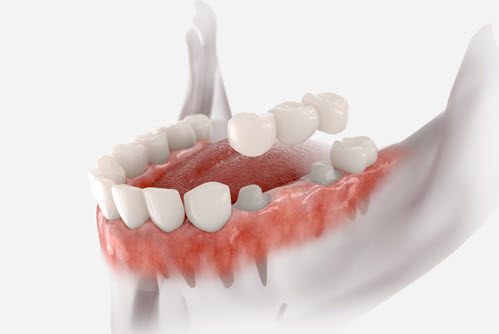 Dental Bridges