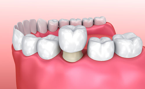 Dental Crowns