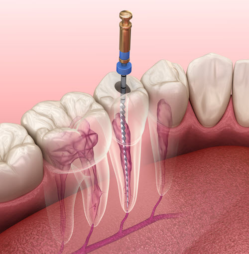 Root Canal Treatment