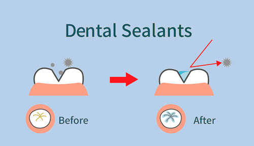 Dental Sealants