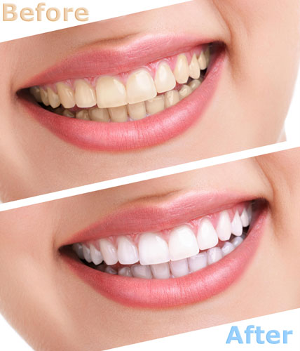 Teeth-Whitening-Before-After