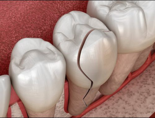 Saving a Damaged Tooth