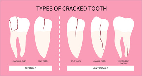 Damaged Tooth