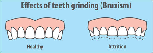 Tooth Grinding