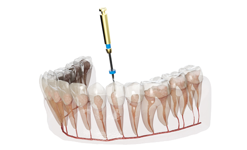 Root Canal