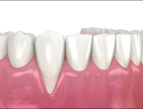 Gum Recession and How to Prevent It for Lasting Oral Health
