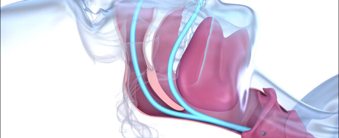 Sleep Apnea