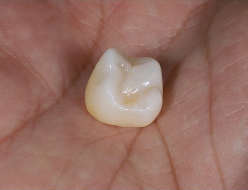 Dental Crowns: What to Expect from a Procedure