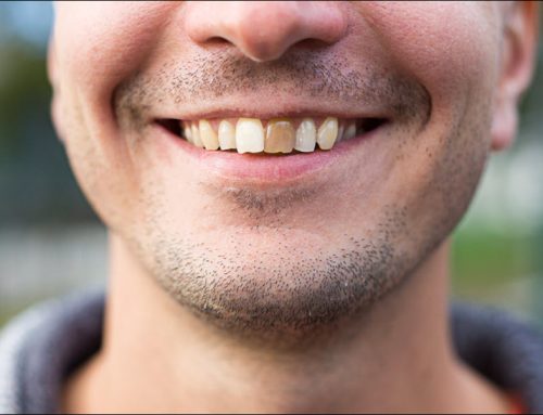 Restoring Damaged Teeth: Modern Solutions for a Healthy Smile