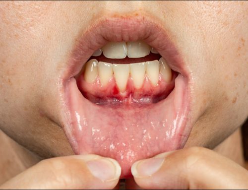 Gum Recession: Causes, Treatment, and Prevention