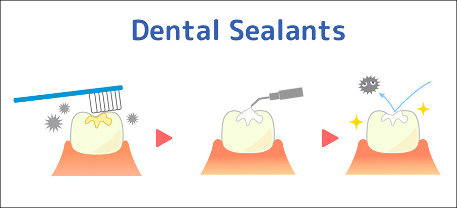 Sealants