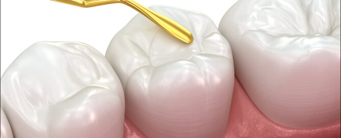Sealants