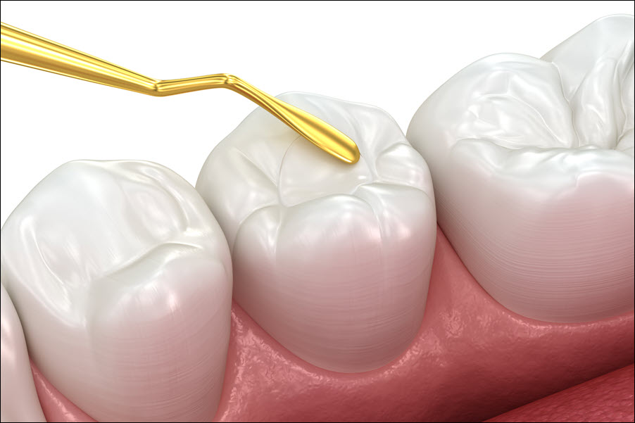 Sealants
