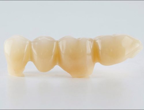 Dental Bridges: A Reliable Solution for Missing Teeth