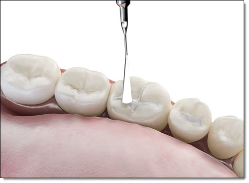 Fillings